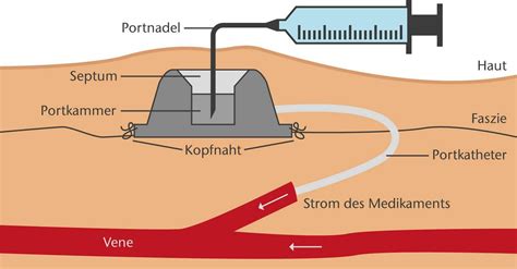 Portversorgung, Portpflege: Anleitung und Prophylaxe。